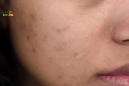5 Penyebab Kulit Muka Kusam dan Berjerawat