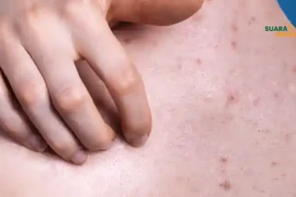 8 Penyebab Jerawat Punggung dan Cara Mengatasinya