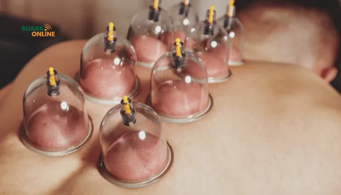 9 Manfaat Bekam untuk Kesehatan, dari Relaksasi hingga Detoksifikasi