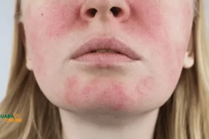Ini Ciri-Ciri Kulit Iritasi Akibat Produk Skincare, Wajib Waspada! 