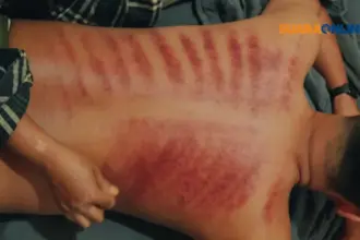 Kerokan Bisa Menghilangkan Gejala Masuk Angin? Kenali Bahaya Kerokan yang Wajib Kamu Ketahui!