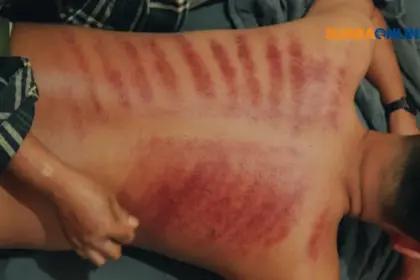 Kerokan Bisa Menghilangkan Gejala Masuk Angin? Kenali Bahaya Kerokan yang Wajib Kamu Ketahui!