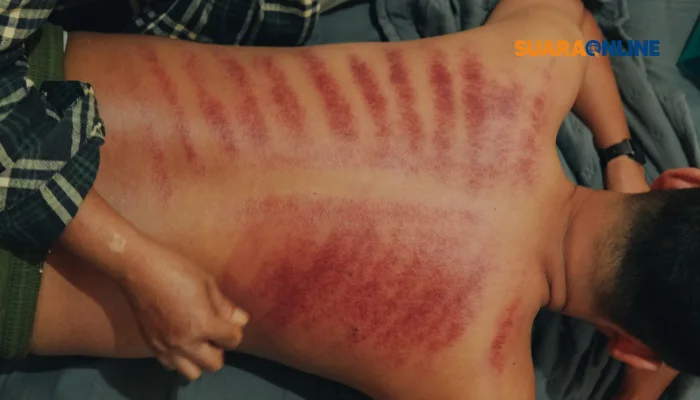 Kerokan Bisa Menghilangkan Gejala Masuk Angin? Kenali Bahaya Kerokan yang Wajib Kamu Ketahui!