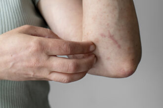 Gejala Campak terlihat dari ruam kemerahan di kulit