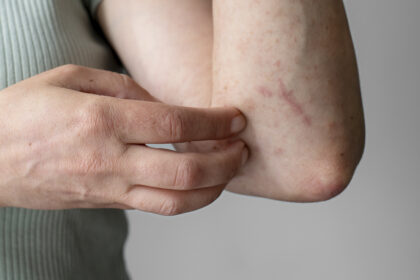 Gejala Campak terlihat dari ruam kemerahan di kulit